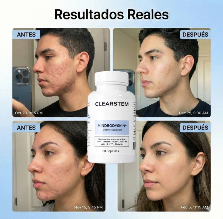 CLEARSTEM - MINDBODYSKIN Suplemento hormonal para el acné - OFERTA 2X1